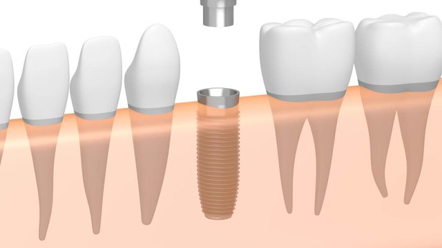3D dental implant/ tooth implant animation - on white background.
