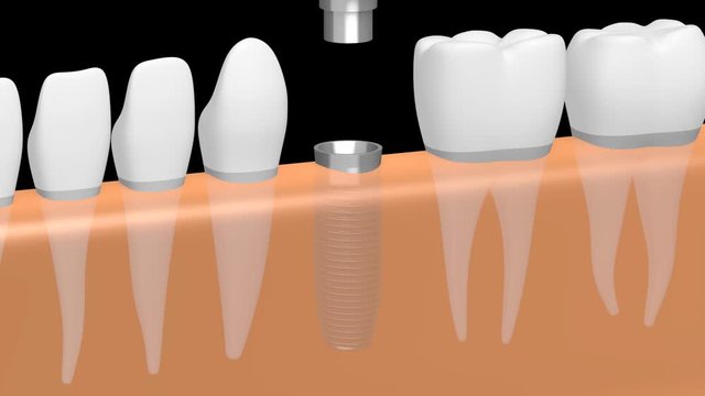 3D dental implant/ tooth implant animation - on black background.
