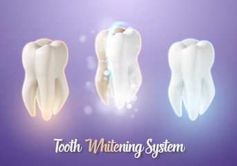 Illustration of 3D Realistic Vector Teeth Cleaning Process. Vector Tooth Cleaning Treatment. Healthcare Stomatology Procedure