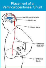 vector illustration of a placement of a ventriculoperitoneal shunt
