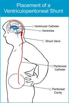 Vector Illustration Of A Placement Of A Ventriculoperitoneal Shunt