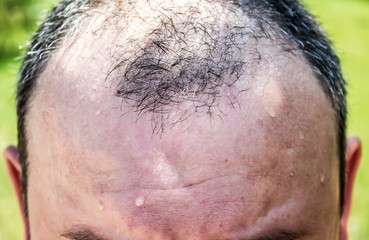 Obraz premium Balding man