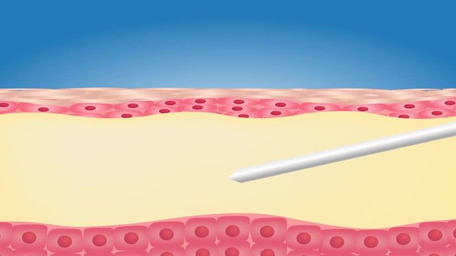 Liposuction before and after , fat , diet , surgery