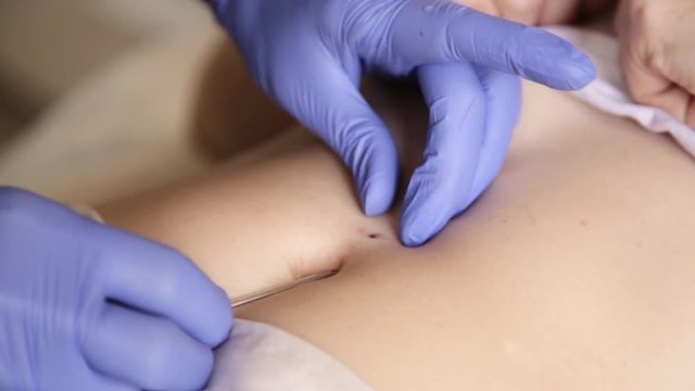Operation to install navel piercing. doctor makes navel puncture
