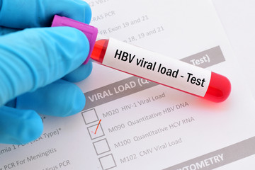 Test tube with blood sample for HBV viral load test