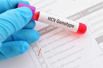 Test tube with blood sample for HCV genotype test