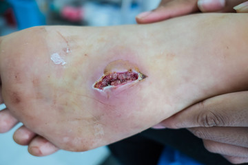 closeup  infection wound in the foot of patients .  - obrazy, fototapety, plakaty