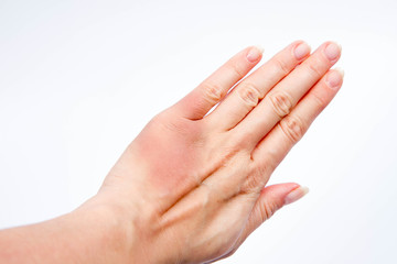 Fototapeta premium Woman's hand with a bruise