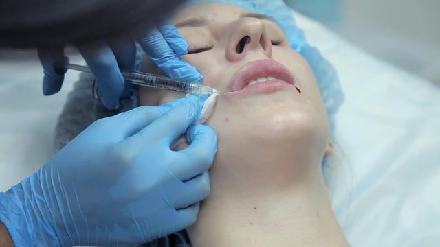 The doctor-cosmetologist introduces Botox into the girl's lips to enlarge them. Lip augmentation in the clinic