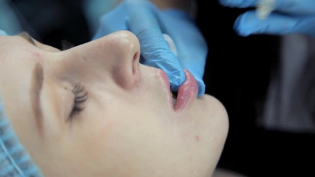 The doctor-cosmetologist introduces Botox into the girl's lips to enlarge them. Lip augmentation in the clinic. Close-up
