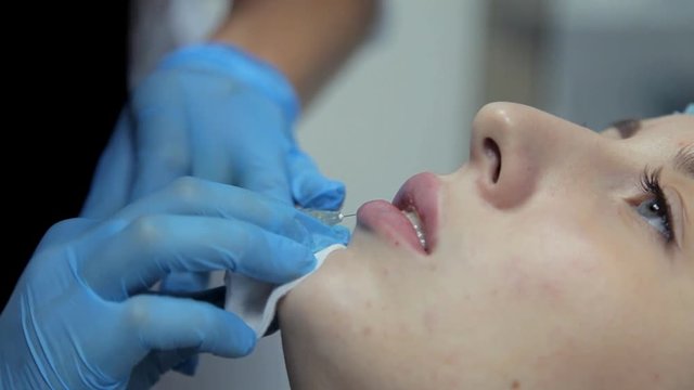In the clinic, a medical cosmetologist injects Botox with a girl to increase her lips. Close-up.
