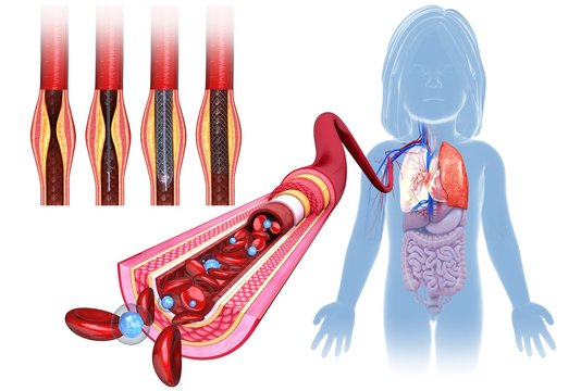 Blocked artery stent treatment, illustration