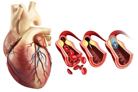Coronary angioplasty stent insertion, illustration