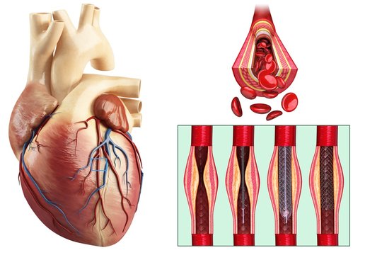 Coronary angioplasty stent insertion, illustration