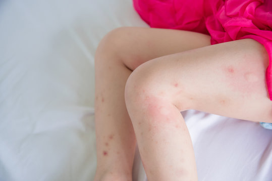 Legs of little girl with swelling spot from mosquitoes bite allergy
