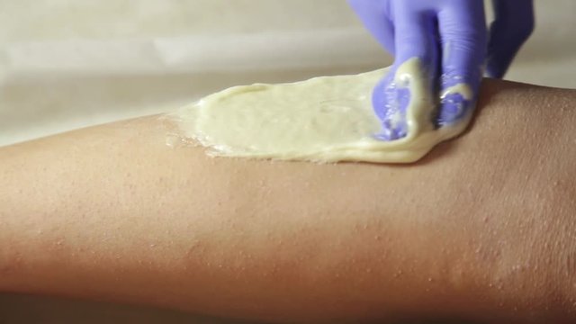 beautician hands in a blue rubber glove remov unwanted leg hair with shugaring.