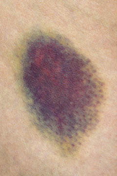 Bruise