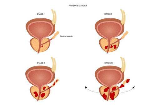 Various stages of a prostate cancer.
