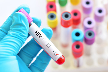 Fototapeta premium HIV positive blood sample