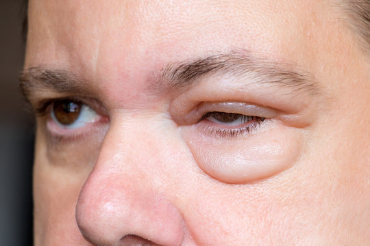 Inflammation of the eyelid. Swelling of the eye after insect bite. A man with sick eyes. Sensitive reaction to an experimental wrinkle cream.