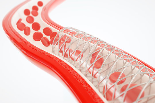 Angioplasty with stent placement- 3D rendering