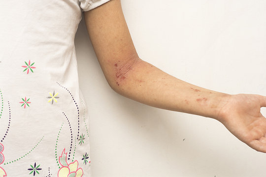 .Atopic dermatitis on the folds of the hands.