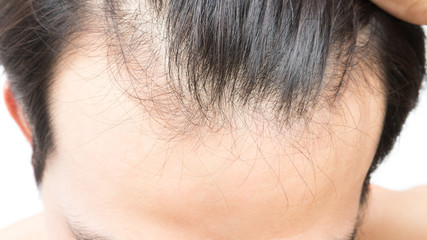 Young man serious hair loss problem for health care shampoo and beauty product concept