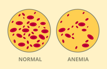 compare between normal blood cell vs anemia disease sick