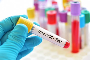 Blood sample for uric acid test, gouty arthritis diagnosis