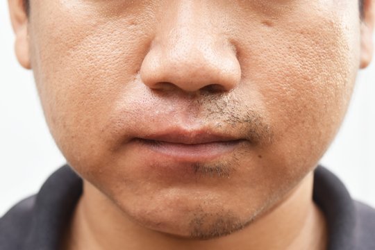 some mustache after withdrawal mustache on surface young asian man face skin do not take care for a long time
