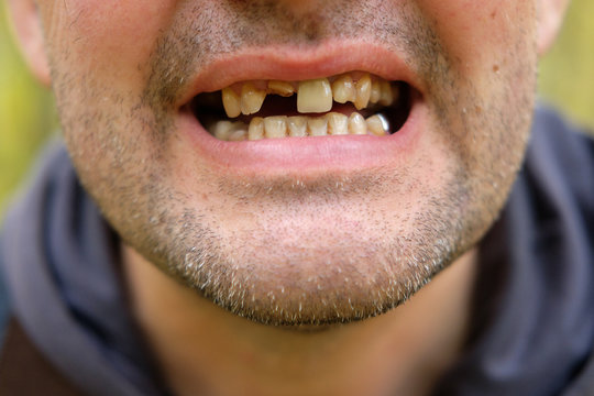 problems with teeth men of the European race