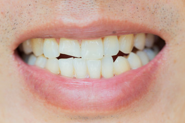 Teeth Injuries or Teeth Breaking in Male. Trauma and Nerve Damage of injured tooth, Permanent Teeth...