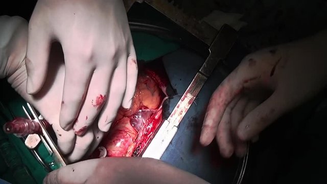 Heart surgery professional doctor hands unique macro video close up in clinic. Struggle for life. Operation on live organ of patient in hospital.