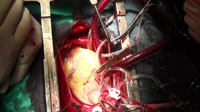 Human heart surgery professional doctor hands unique macro video in clinic. Struggle for life. Operation on live organ of patient in hospital.