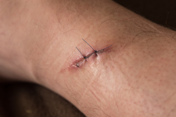 surgical sutures on the leg