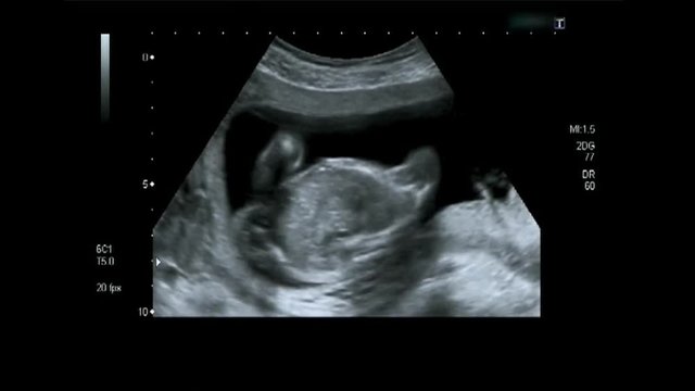 Ultrasound of fetus spine.