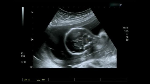 Ultrasonography of Fetus inside woman's womb.