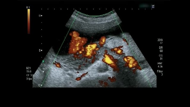 Obstetric Ultrasonography Ultrasound Echography of a fourth month fetus with histogram colors.