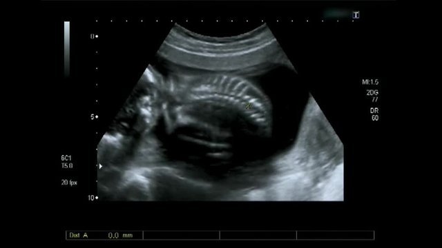 Obstetric Ultrasonography Ultrasound Echography of a fourth month fetus spine.