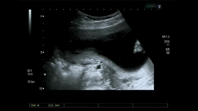 Ultrasound echography of third month fetus. Leg and spine.