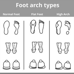 Foot arch types vector infographics. Set of flat foot, high arch