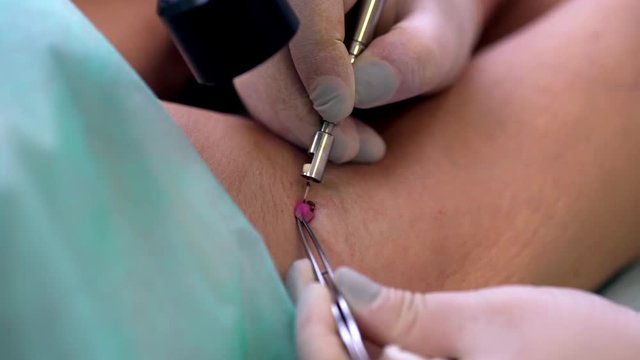 cosmetician cauterizing removing big mole from woman's armpit with laser lying on table in medical center closeup 