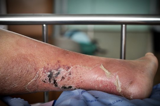 The feet of people with diabetes, dull and swollen. Due to the toxicity of diabetes, ulceration
