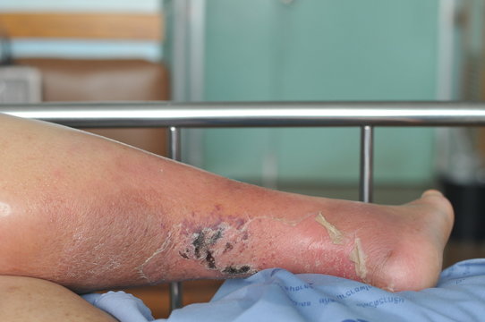The feet of people with diabetes, dull and swollen. Due to the toxicity of diabetes, ulceration
