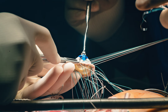 Team Of Surgeons Minimally Invasive Aortic Valve Surgery Replacement With Sutures Placed Of Each Commissure Suspended. Sutures Are Placed Through The Annulus And Through The Aortic Prosthesis And Tied