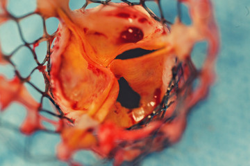 heart valve surgery for removing expandable transcatheter aortic valve implantation remove old...