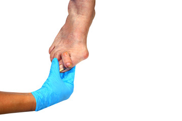 Medecin, valgus bunion, leg with deformation valgus hallux (Bunion), consequence of failure of treatment, isolated on white background with clipping path, place for text