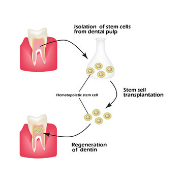 Stem cells from the dentin of the tooth is used to regenerate diseased tooth dentin. Infographics. Vector illustration