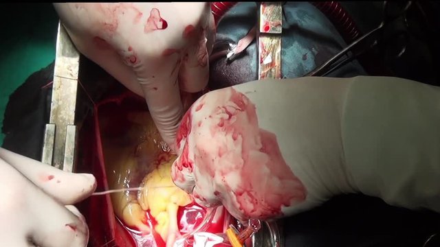 Heart surgery professional doctor hands unique macro video in clinic. Struggle for life. Operation on live organ of patient in hospital.