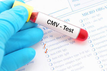 Obraz premium Blood sample with requisition form for cytomegalovirus (CMV) test